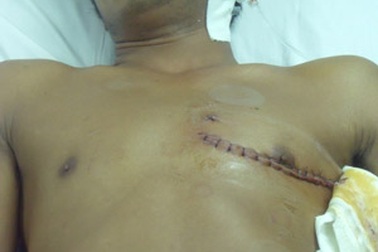 Cứu sống nạn nhân bị mảnh kính đâm thủng tim