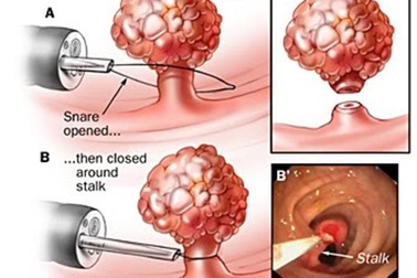 Chủ quan, polyp túi mật lành tính thành ung thư