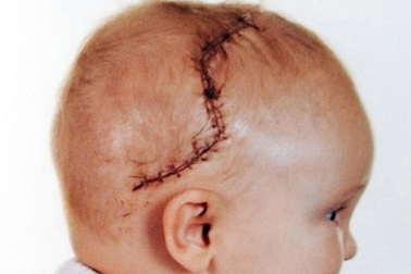 Sự hồi phục kỳ diệu của bé gái bị bổ đôi hộp sọ