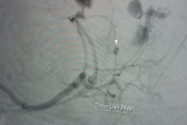 Cần Thơ: Điều trị vỡ lách không cần phẫu thuật