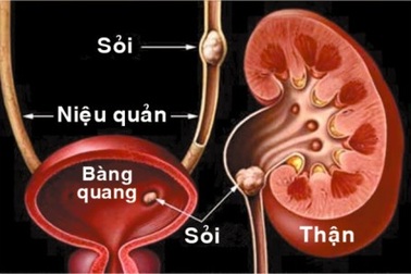 Bé trai 9 tuổi đã bị sỏi thận