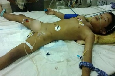 Nguy kịch bé trai bị ong đốt hơn 60 vết