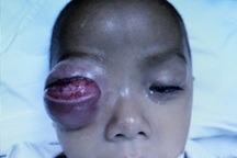 Bé trai 16 tháng suýt mất mắt phải vì viêm xoang