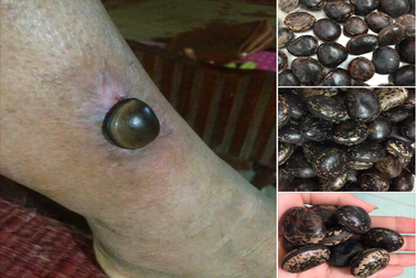 Thực hư hạt đậu lào 'thần thánh' hút nọc rắn, trị chó dại cắn