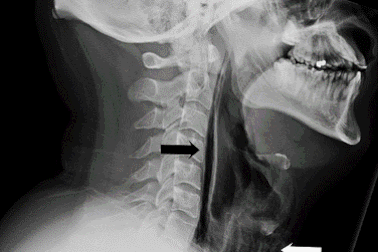 Một người đàn ông bị vỡ cổ họng khi cố nhịn hắt hơi