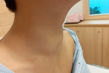 Cậu bé 15 tuổi nói khàn, khó thở như cá trên cạn vì u tuyến giáp di căn