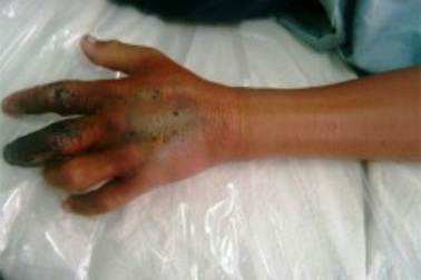 Bị hoại tử bàn tay vì bắt rắn hổ mèo