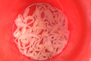 Xổ nguyên con sán xơ mít dài 9m sau 2 tháng đau bụng từng cơn