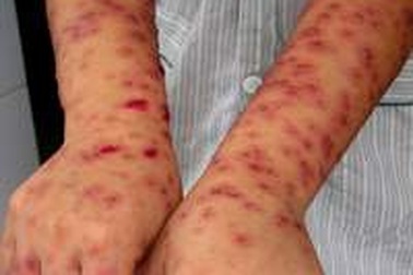 Chớ coi thường mụn nước