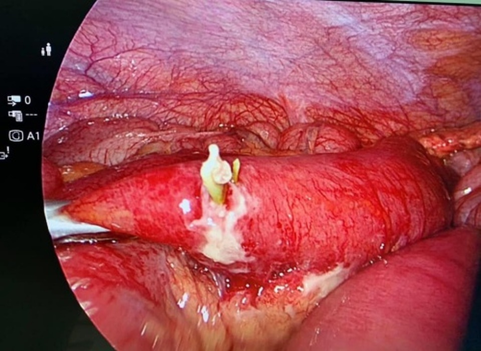 Người đàn ông bị mảnh xương cá dài 2cm đâm thủng ruột non - 1 Người đàn ông bị mảnh xương cá dài 2cm đâm thủng ruột non - 1