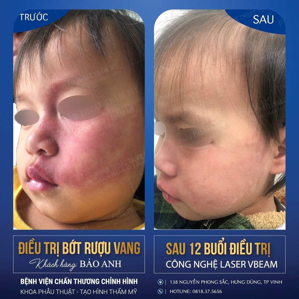 Hỗ trợ chi phí điều trị u máu, bớt máu cho trẻ có hoàn cảnh khó khăn - 4 Hỗ trợ chi phí điều trị u máu, bớt máu cho trẻ có hoàn cảnh khó khăn - 4