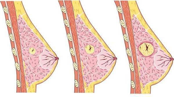 Xử lý dứt điểm tổn thương nghi ngờ ung thư vú không cần mổ - 1