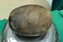 Phát hiện viên sỏi nặng gần 1kg trong bàng quang nam bệnh nhân