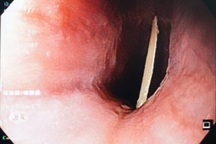 Nuốt vội thức ăn, bị xương đâm thủng thực quản