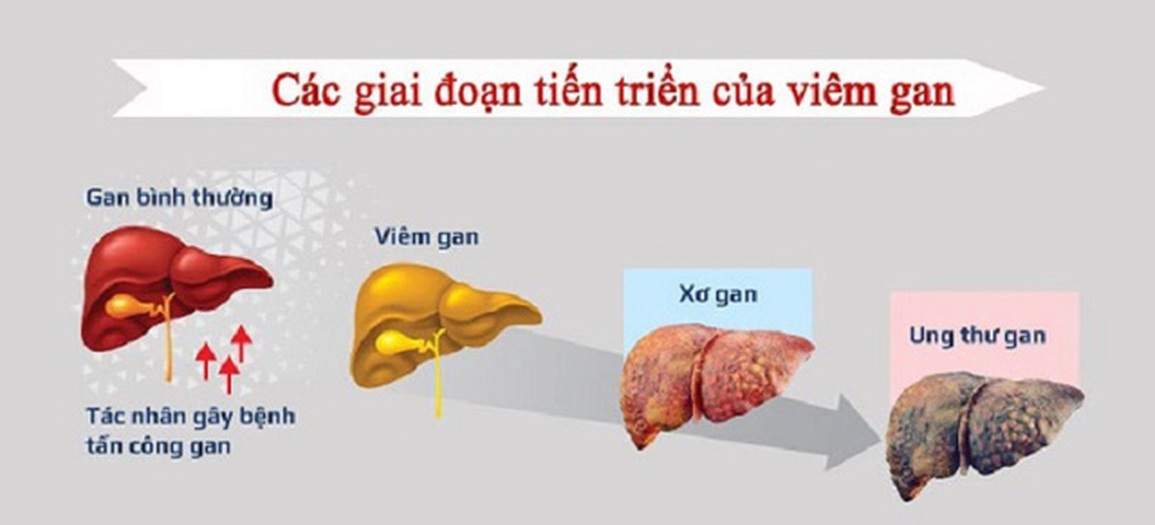 Những dấu hiệu cảnh báo ung thư gan giai đoạn đầu - 2 Những dấu hiệu cảnh báo ung thư gan giai đoạn đầu - 2