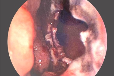 Nữ bệnh nhân bị hoại tử vách ngăn mũi vì xông thuốc không rõ nguồn gốc