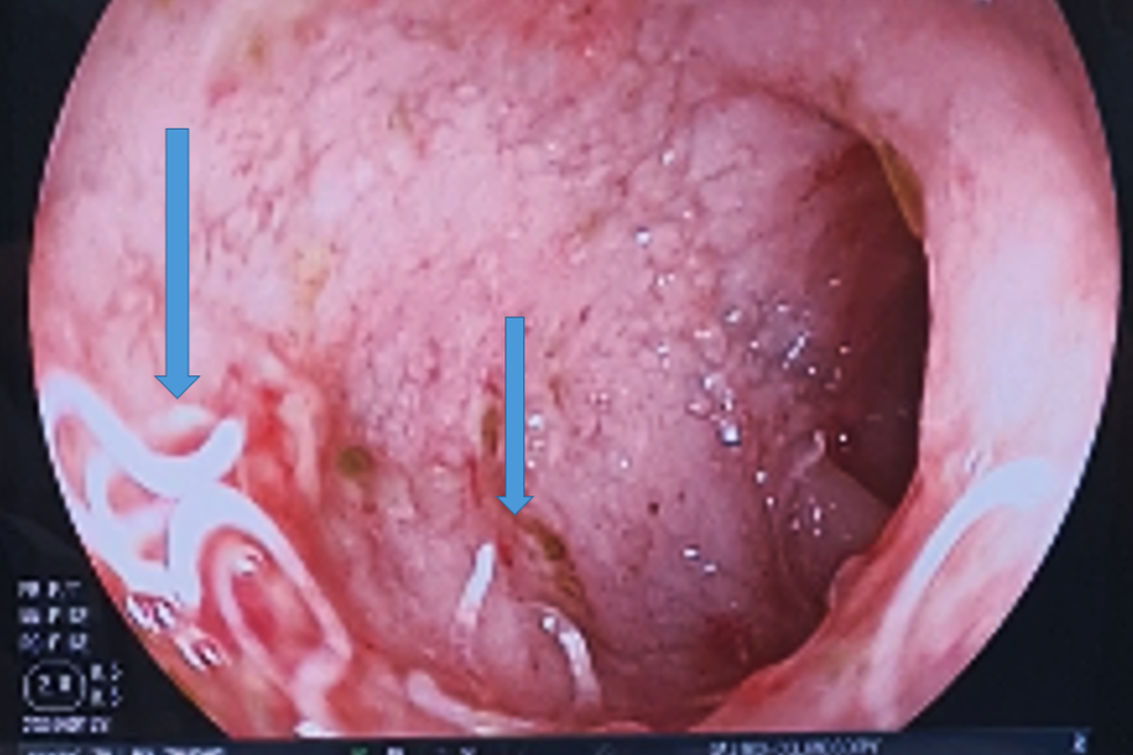 Mẹ cho uống sữa pha bằng nước sông, bé gái 3 tháng tuổi nhiễm giun nặng - 2 Mẹ cho uống sữa pha bằng nước sông, bé gái 3 tháng tuổi nhiễm giun nặng - 2