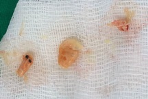 Vì một con tép, bé gái 2 tuổi suýt chết khi mẹ đút cho ăn