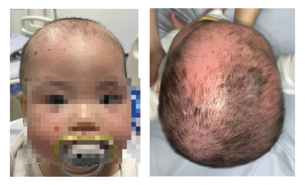 Tắm lá, bé trai 8 tháng tuổi nứt da đầu, bong tróc khắp mặt - 2 Tắm lá, bé trai 8 tháng tuổi nứt da đầu, bong tróc khắp mặt - 2