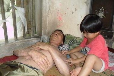 Nỗi đau đớn của người đàn ông mắc bệnh vảy nến hơn 20 năm