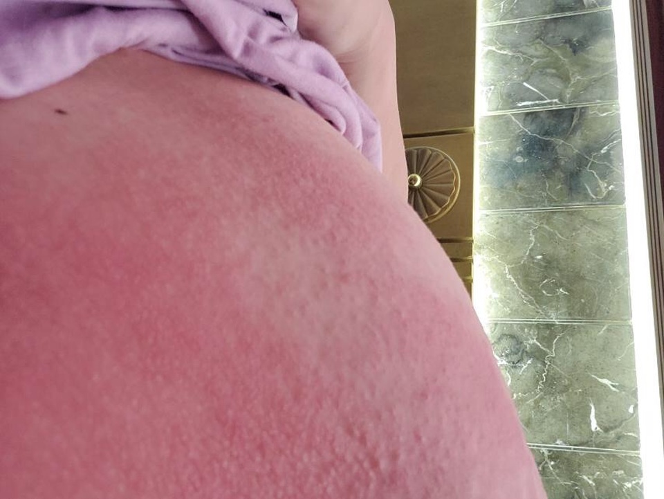 Thoa rượu gừng làm đẹp sau sinh, sản phụ nổi mẩn ngứa toàn thân - 2 Thoa rượu gừng làm đẹp sau sinh, sản phụ nổi mẩn ngứa toàn thân - 2