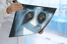 Triệu chứng cảnh báo ung thư phổi tế bào nhỏ