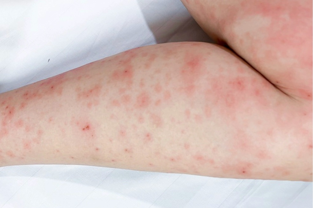 Mưa lớn kéo dài nhiều ngày, hàng ngàn người ở TPHCM đi khám bệnh da liễu - 1 Mưa lớn kéo dài nhiều ngày, hàng ngàn người ở TPHCM đi khám bệnh da liễu - 1