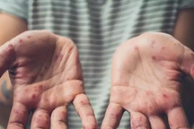 Nhiều nước chạy đua với thời gian ngăn đậu mùa khỉ bùng phát thành đại dịch