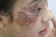 Cô gái gặp "họa" vì thoa kem mua trên mạng giá 600.000 đồng