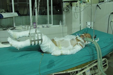 Bỏng 85% cơ thể do ngã vào nồi cám lợn đang sôi