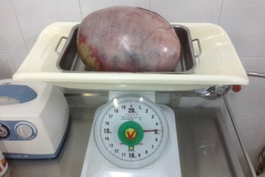 23 tuổi mang khối u buồng trứng 5kg