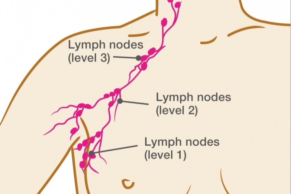Nổi hạch có phải bị ung thư? - 2