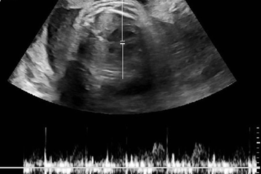 Mẹ 2 con bất ngờ phát hiện mang thai "bí ẩn" sắp sinh, suýt mất mạng