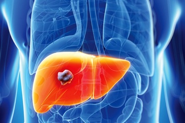 Ung thư gan giai đoạn cuối sống được bao lâu?