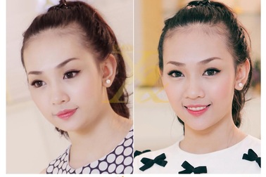 Theo chân khách hàng độn cằm V-line tại thẩm mỹ viện Xuân Hương