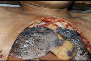 “Phổi” đen kịt vì ám khói 400 điếu thuốc lá