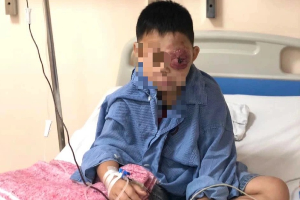 Cậu bé 8 tuổi mang khối u máu khủng sắp vỡ ở mắt - 1 Cậu bé 8 tuổi mang khối u máu khủng sắp vỡ ở mắt - 1