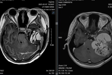 Bác sĩ thực hiện ca đại phẫu 14 giờ cứu thiếu nữ thoát khỏi u não nguy hiểm