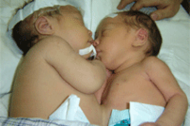 Bé Cu đã được phẫu thuật chuyển gốc động mạch