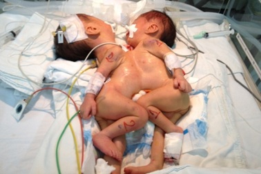 Thêm một cặp song sinh trai dính nhau phức tạp