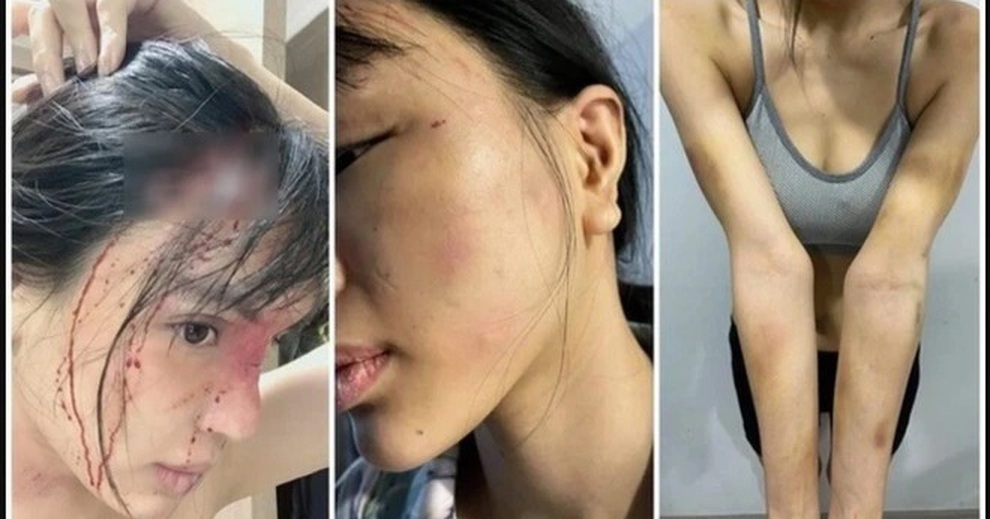 Siêu mẫu nghi bị bạo hành dã man: Khi yêu thương kết thúc bằng… nắm đấm? - 1 Siêu mẫu nghi bị bạo hành dã man: Khi yêu thương kết thúc bằng… nắm đấm? - 1