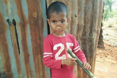 Mũi bé trai 5 tuổi to như quả ổi vì bị "tụt não"