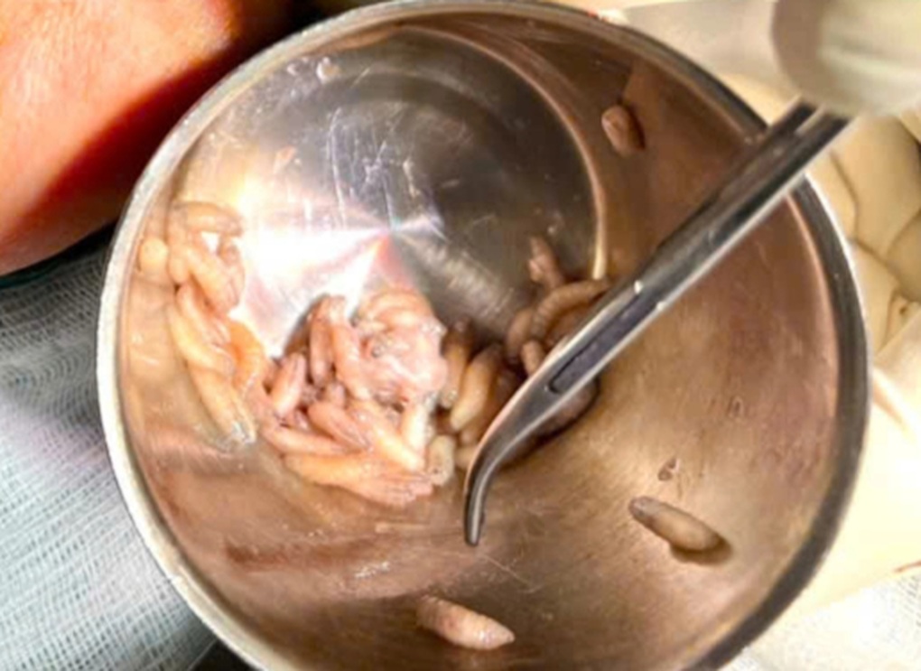 Doctor removed more than 100 maggots nesting in patient's mouth - 1 Bác sĩ gắp hơn 100 con giòi làm ổ trong miệng bệnh nhân - 1