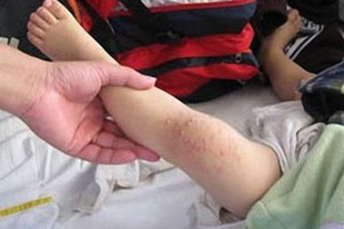 Trên 100 ngàn ca mắc tay chân miệng trong năm 2011