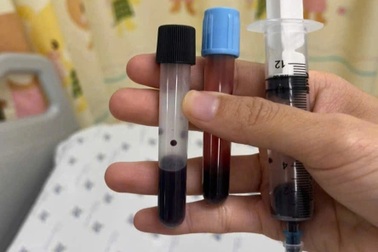 Máu bé gái chuyển màu nâu sau bữa trưa, cảnh báo thói quen nấu ăn nguy hiểm