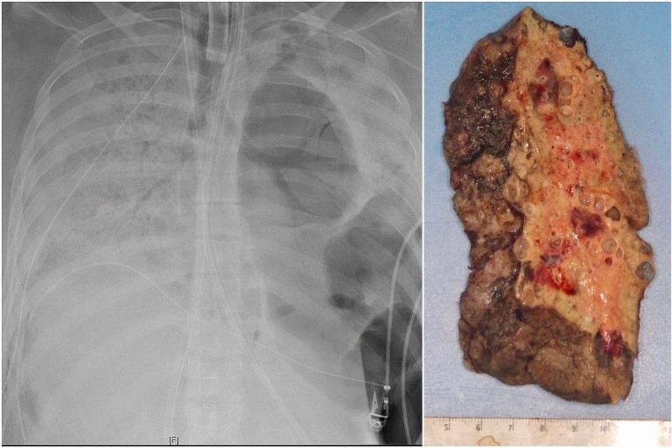 Phổi đông đặc của bệnh nhân mắc Covid-19 trước khi được cấy ghép tại Mỹ - 1