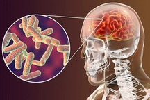 Giải mã những hiểu lầm về viêm màng não