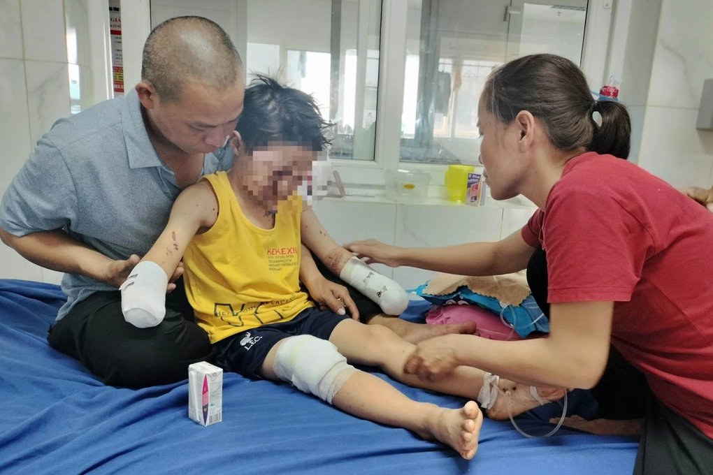 Bé trai 8 tuổi mất cả hai bàn tay sau tiếng nổ lớn - 2 Bé trai 8 tuổi mất cả hai bàn tay sau tiếng nổ lớn - 2