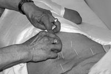 Châm cứu giảm béo: Ứng dụng sáng tạo của y học dân tộc