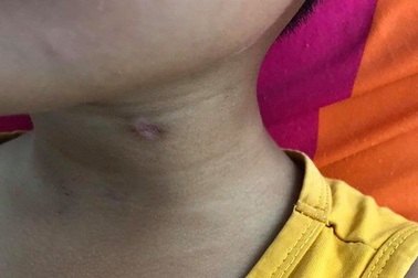 Nghịch súng, anh 9 tuổi bắn xuyên cổ em trai 6 tuổi